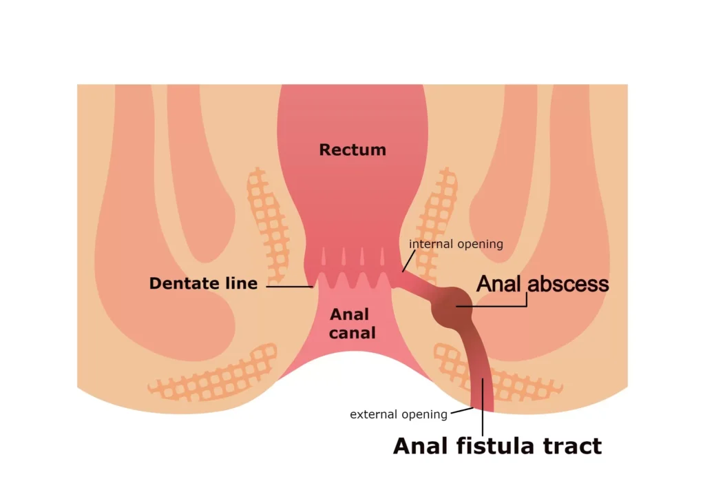 fistula - Gastrovedics